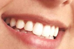 implantes-dentarios-butanta1394553175